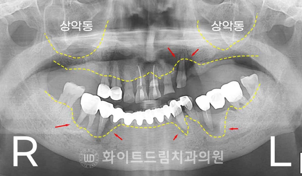 서울전체임플란트잘하는치과, 왜 치주염이 심해지면 반대교합까지 생길까요? (치주염 전체 임플란트 CASE) 관련 이미지 7
