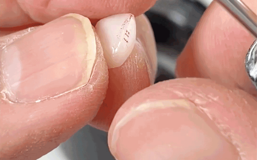 라미네이트 치료에 대해 알아보면? 관련 이미지 5