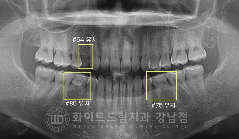 영구치 결손, "유치가 흔들려요." 성인 잔존 유치 발치 후 바로 임플란트 식립! 관련 이미지 3