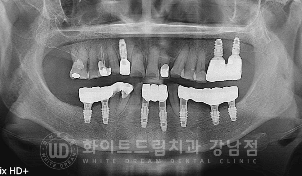 잇몸뼈가 없다는 게 무슨 말일까? "틀니를 오래 사용해서 잇몸뼈가 없대요" 임플란트 잘하는 강남치과 관련 이미지 19