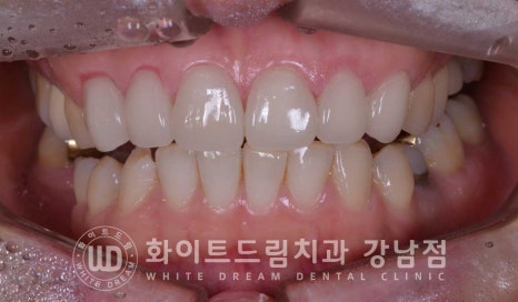앞니 원데이라미네이트 / 떨어진 앞니 레진 & 벌어진 앞니, 라미네이트로 당일 개선 ★ 관련 이미지 11