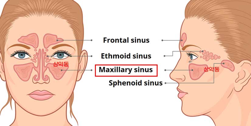 상악 어금니 임플란트 치료 시 동반되는 "상악동 거상술" 이란? 관련 이미지 4