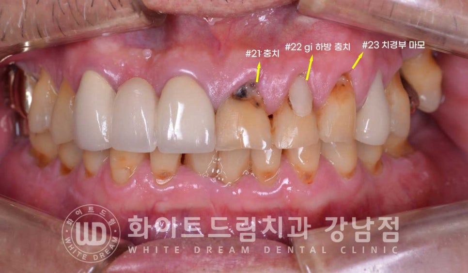 앞니 충치 라미네이트 치료 / "옆 크라운과 치아 색상을 맞추고 싶어요" 관련 이미지 5