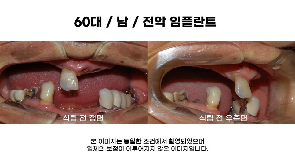 전악 임플란트 과정 및 후기 전후사례확인하고 임플란트가격 비용 알아보기 관련 이미지 1