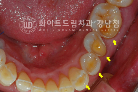 강남역 임플란트치과 / "어금니가 없고 이갈이가 심해요" 강남역 화이트드림치과 관련 이미지 7