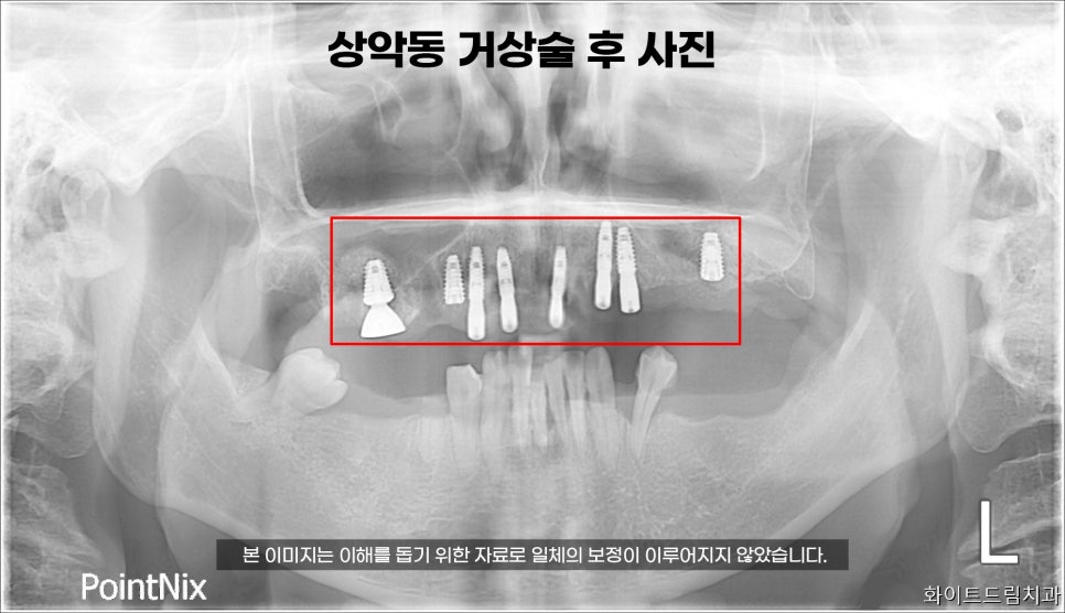 40대 전악 임플란트 식립 증례 관련 이미지 3