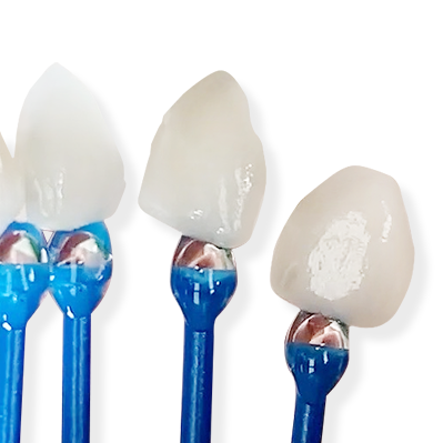 라미네이트 치료에 대해 알아보면? 관련 이미지 16