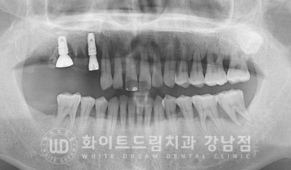 발치 즉시 임플란트 "내원 당일 발치 후 바로 임플란트 식립!" 관련 이미지 9