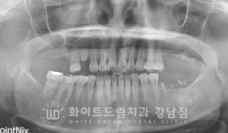 신경치료 후 크라운을 해야 하는 이유 / 크라운을 안 해 부러진 치아 임플란트 치료 case 관련 이미지 6