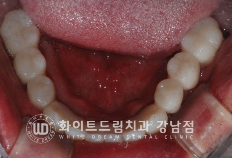 40대 전체임플란트 / 디지털스캔바디를 이용한 전체 임플란트 치료 사례 (Feat. 치주염) 관련 이미지 22