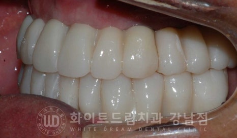 전체 임플란트 치료 기간과 내원 횟수는? "치과에 자주 가기 어려워요." 관련 이미지 29