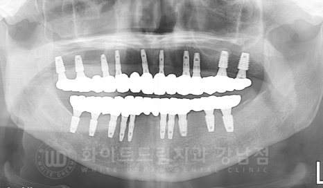 서울 전체임플란트 기간 / 전체 임플란트 7개월 완성, 무치악 임플란트 관련 이미지 3