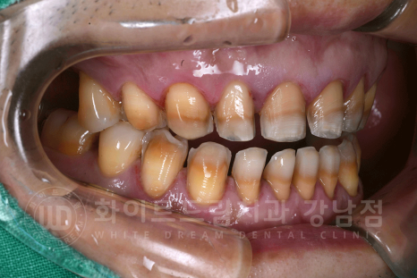 강남역 인근 치과 / 테트라사이클린(tetracycline) 치아 변색 / 라미네이트로 개선! 관련 이미지 10