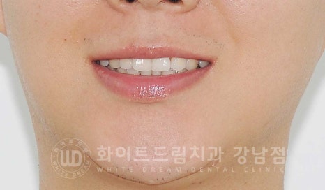 틀어진 치아 라미네이트, 틀어지고 색이 다른 앞니가 고민이에요. 관련 이미지 3