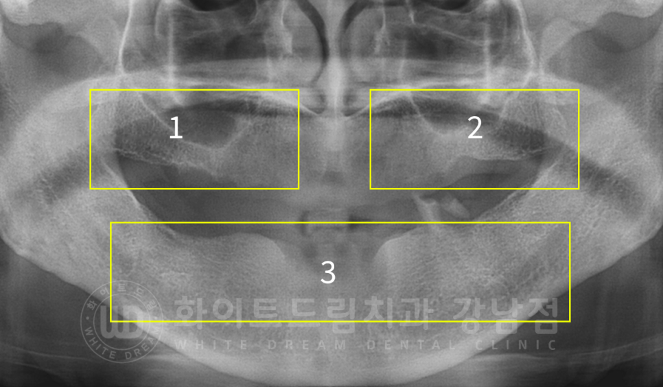 서울 전체임플란트 기간 / 전체 임플란트 7개월 완성, 무치악 임플란트 관련 이미지 7