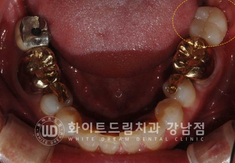 강남역 임플란트재수술 치과 / "임플란트가 흔들려요!" 임플란트 주위염 관련 이미지 14