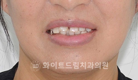 강남역전체임플란트 / 발치 후 즉시 식립, 무조건 누구나 3개월로 끝낼 수 있는 것일까? 강남역화이트드림치과 관련 이미지 18