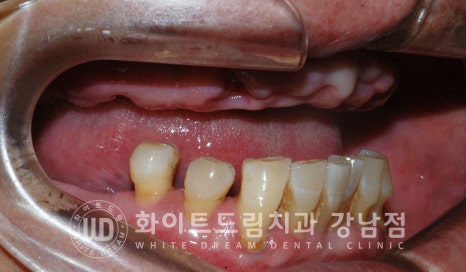 상악 풀케이스임플란트 사례 / "지인 추천으로 인천에서 왔어요." 관련 이미지 16