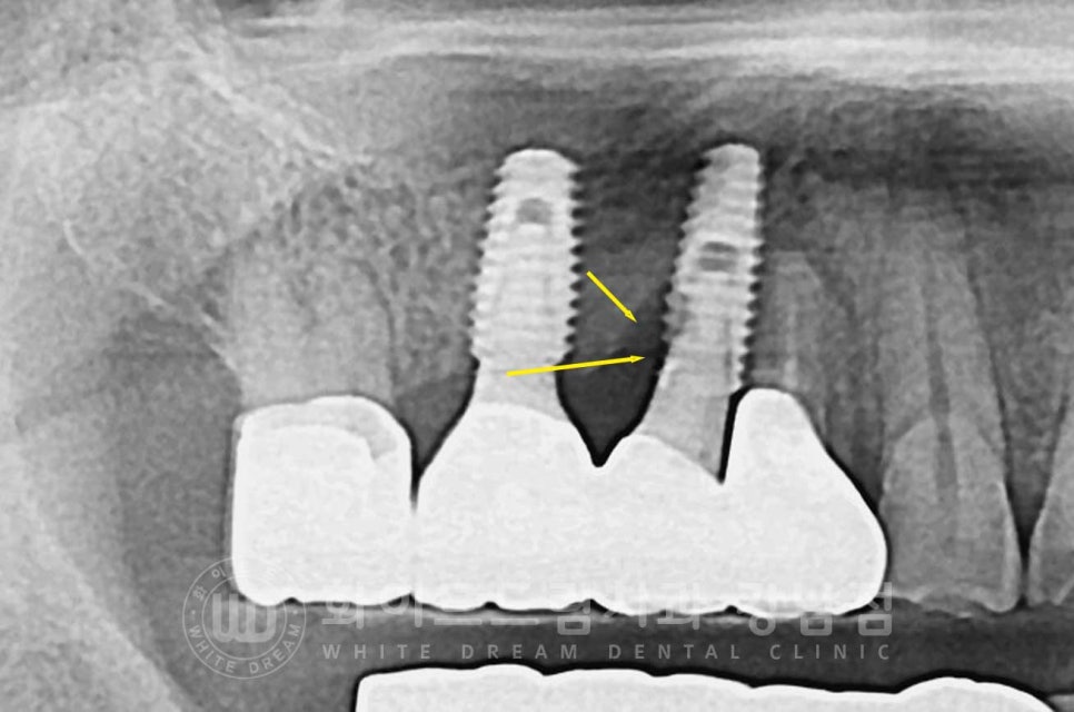 임플란트 재수술의 주원인, "임플란트 주위염과 임플란트 찢어짐!" 관련 이미지 4