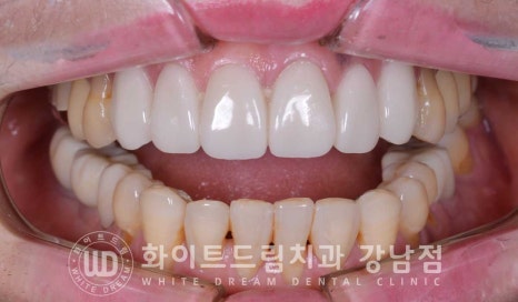 앞니라미네이트 교체 "5년 전에 한 라미네이트가 뻗쳐 보여요" 예쁘게 치료할 수 있나요? 관련 이미지 14