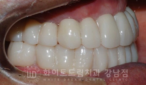 전체 임플란트 치료 기간과 내원 횟수는? "치과에 자주 가기 어려워요." 관련 이미지 27