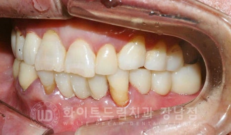 잇몸뼈가 없다는 게 무슨 말일까? "틀니를 오래 사용해서 잇몸뼈가 없대요" 임플란트 잘하는 강남치과 관련 이미지 18