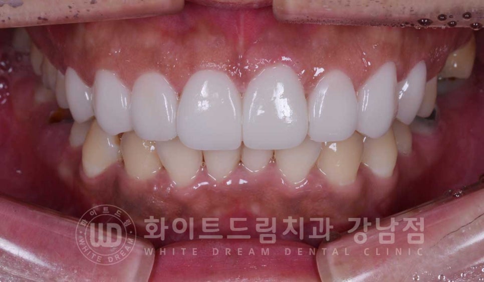 틀어진 치아 라미네이트, 틀어지고 색이 다른 앞니가 고민이에요. 관련 이미지 12