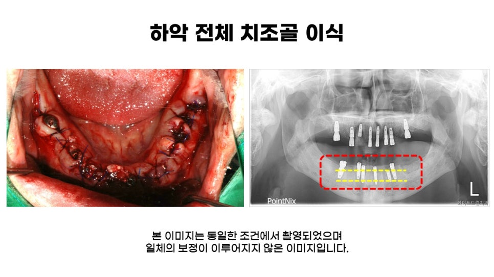 40대임플란트식립후기 및 어금니임플란트 가격, 종류 알아보기 위해 관련 이미지 8