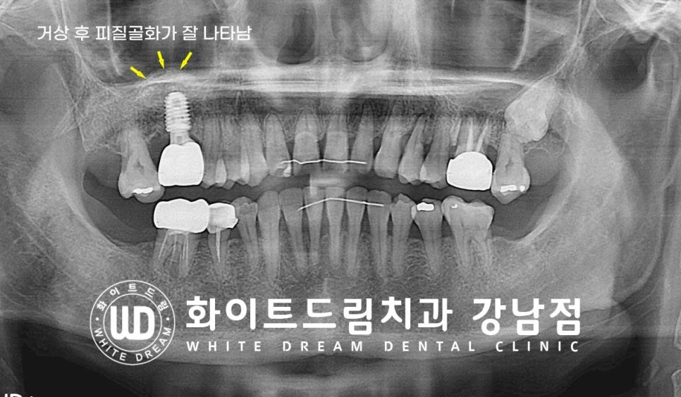 상악 어금니 임플란트 치료 시 동반되는 "상악동 거상술" 이란? 관련 이미지 9