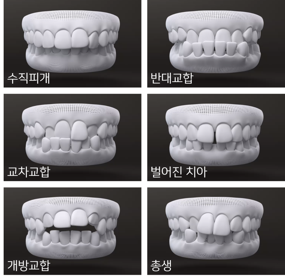 투명교정 시작하기전에 관련 이미지 15