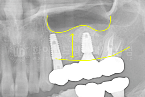 강남역 어금니 임플란트 "어금니가 부러졌어요" 상악동 거상술(lateral approach) 관련 이미지 12