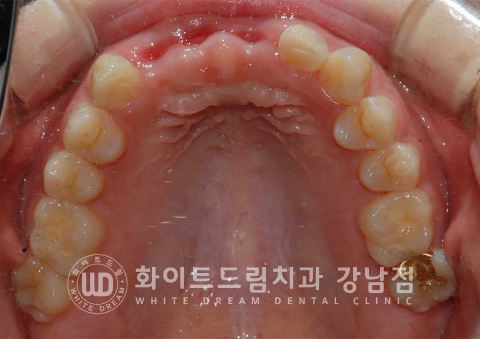 앞니 빠짐 임플란트 / 사고로 인한 앞니 탈구. 앞니 임플란트 치료는? 관련 이미지 2