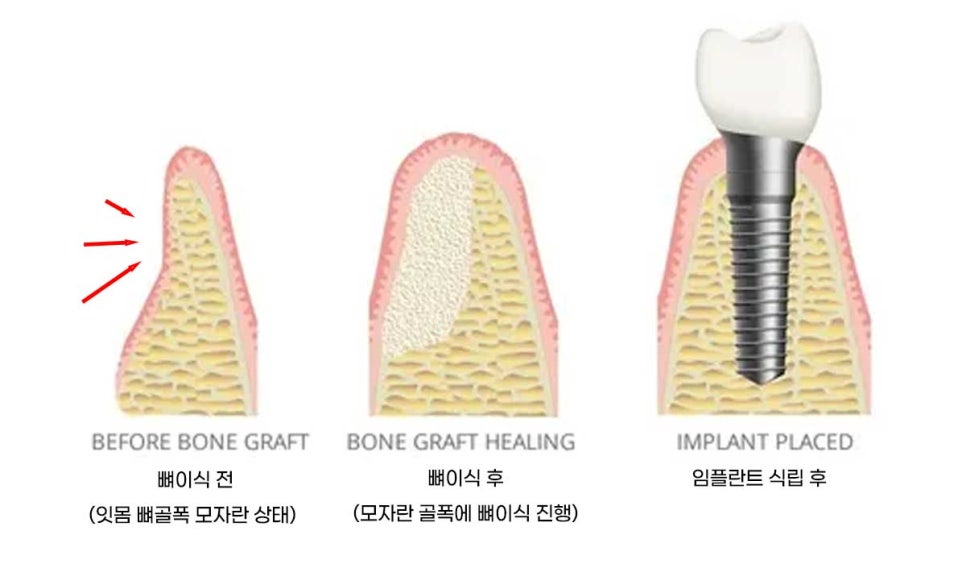 전체 임플란트 치료 기간과 내원 횟수는? "치과에 자주 가기 어려워요." 관련 이미지 12