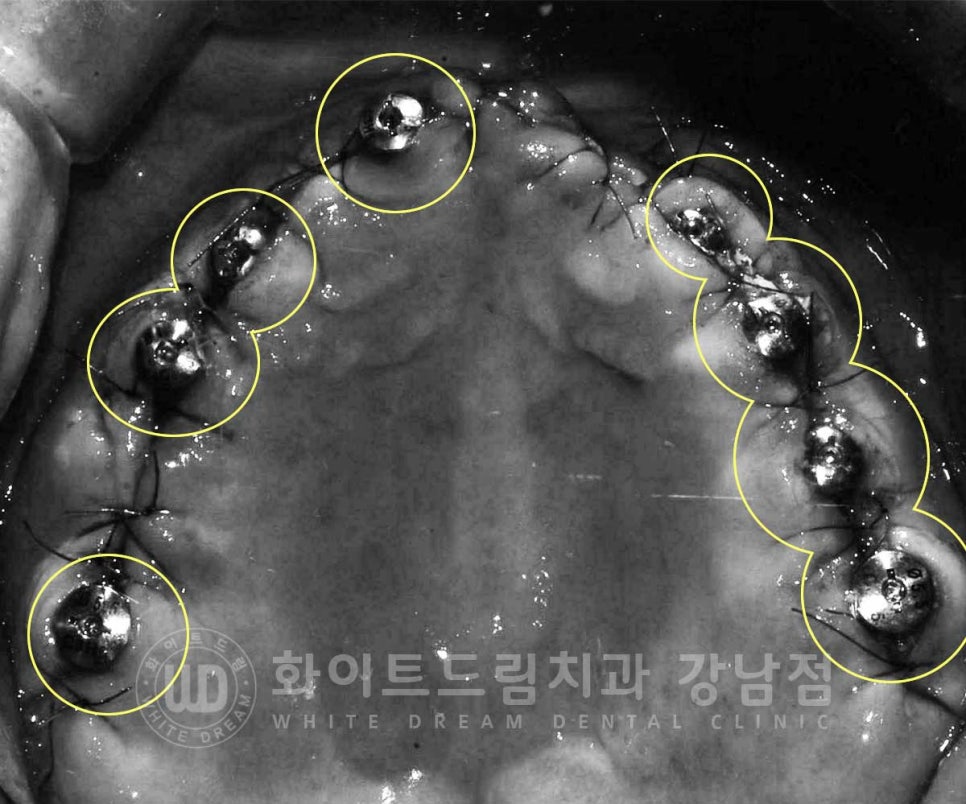 임플란트 재수술 잘하는치과 / 재수술과 전체 임플란트 치료를 동시에! 관련 이미지 8