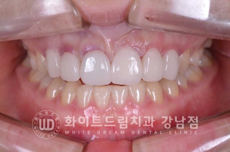 벌어진 앞니라미네이트 / "왜소치로 치아가 벌어졌어요" 치료 사례 관련 이미지 2