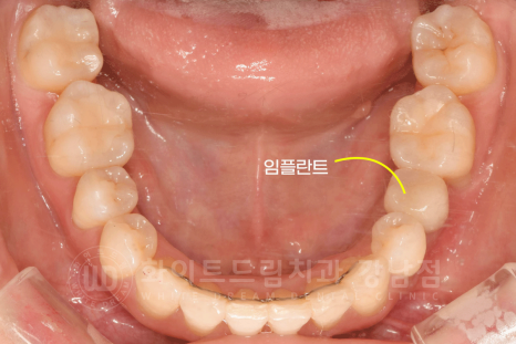 강남 덧니 비발치교정 / 임플란트와 치아교정 동시 진행 case 리뷰. 관련 이미지 19