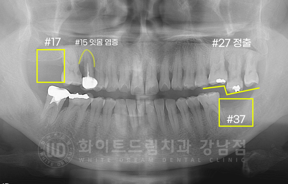 서초동 어금니 임플란트 / 강남역 화이트드림치과 : 상악동 거상술 (crestal approch) 관련 이미지 2