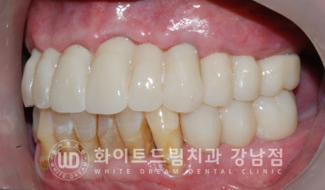 상악 풀케이스임플란트 사례 / "지인 추천으로 인천에서 왔어요." 관련 이미지 19