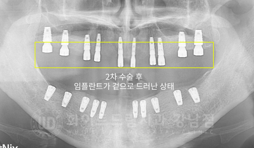 서울 전체임플란트 기간 / 전체 임플란트 7개월 완성, 무치악 임플란트 관련 이미지 11