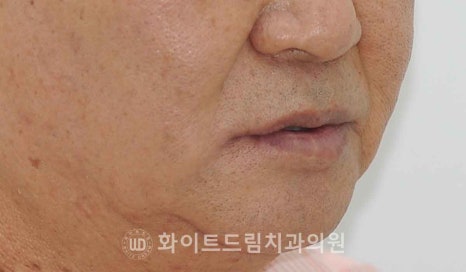 서울전체임플란트잘하는치과, 왜 치주염이 심해지면 반대교합까지 생길까요? (치주염 전체 임플란트 CASE) 관련 이미지 22