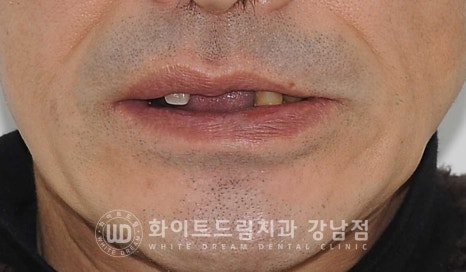 치주염 전체임플란트, 염증으로 인한 상악동 천공 & 신경관 가까이 녹은 잇몸뼈. 임플란트 식립 가능할까? 관련 이미지 1