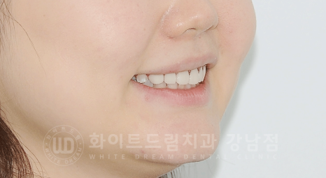 강남역 라미네이트 "치아가 작고 벌어졌어요" 거미스마일 + 벌어진 치아 개선 관련 이미지 6