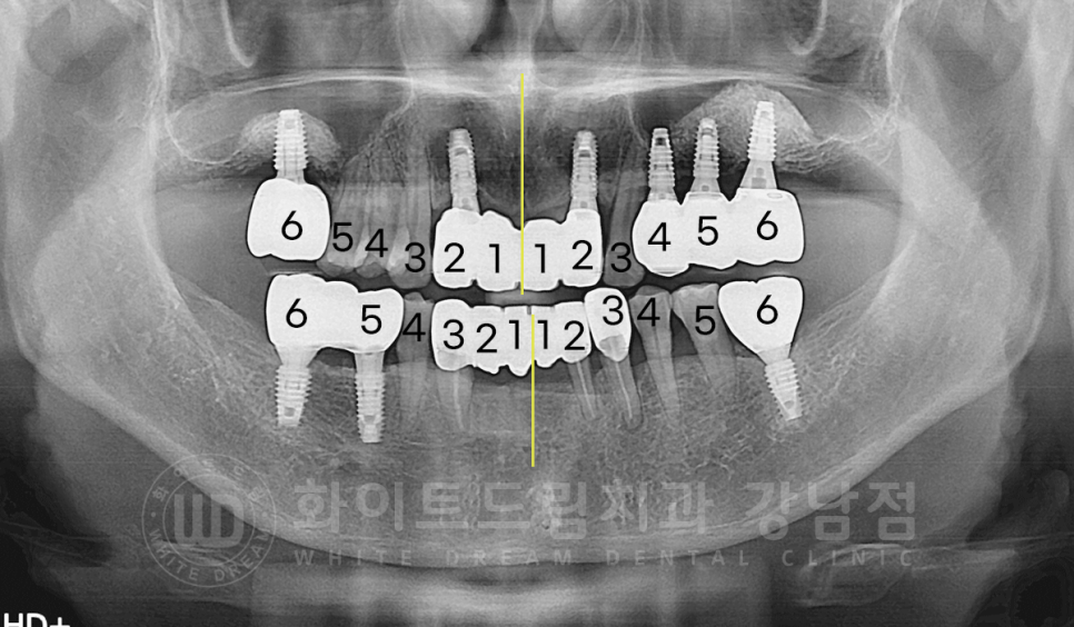 서초동 치과 추천 / "임플란트 개수를 줄이는 식립 방법은?" 강남 화이트드림치과 임플란트 관련 이미지 8