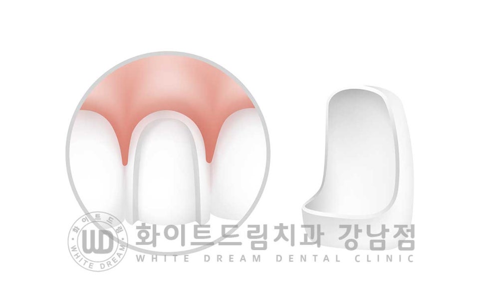 벌어진 앞니 라미네이트 / 50대 시니어 라미네이트 치료 사례 관련 이미지 5