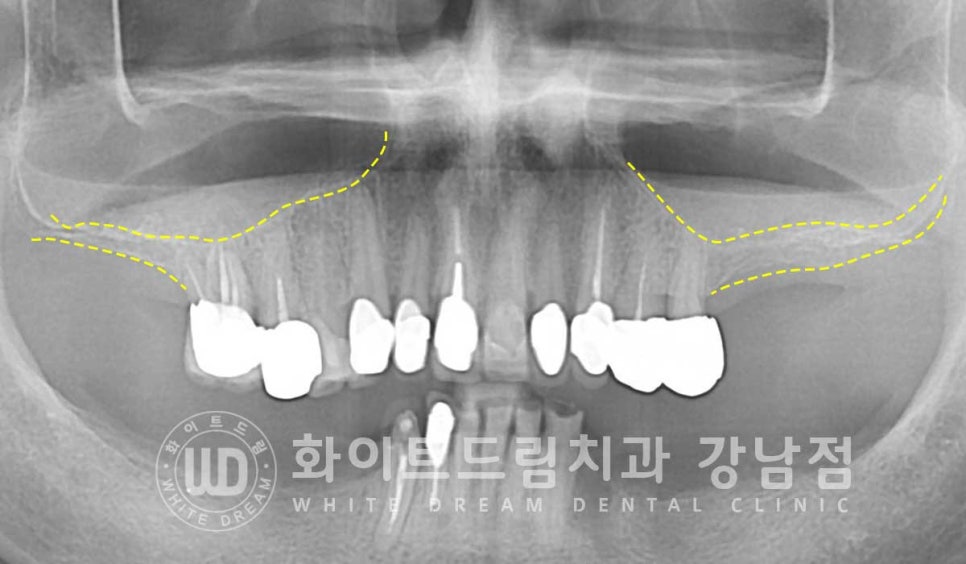 임플란트 개수를 줄일 수 있는 방법? (+치아를 발치한지 오래되었나요?) 관련 이미지 5