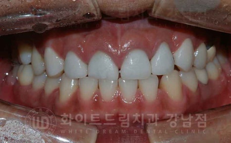 역삼역 앞니 치료  "예전에 한 크라운, 라미네이트 바꾸고 싶어요" 라미네이트 & 크라운 재치료 관련 이미지 2