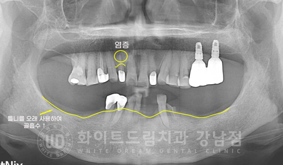 잇몸뼈가 없다는 게 무슨 말일까? "틀니를 오래 사용해서 잇몸뼈가 없대요" 임플란트 잘하는 강남치과 관련 이미지 7