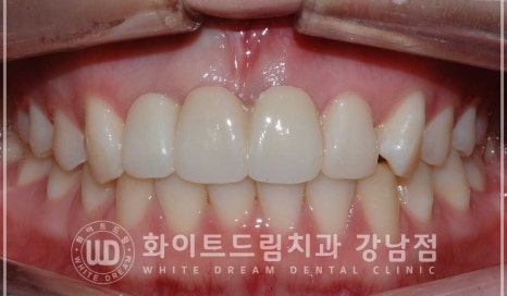 사고당한 앞니치료, "흔들리고 점점 변색돼요." 앞니 임플란트 & 신경치료 관련 이미지 2