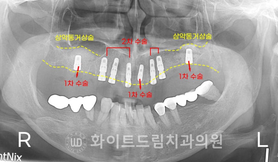 강남역전체임플란트 / 발치 후 즉시 식립, 무조건 누구나 3개월로 끝낼 수 있는 것일까? 강남역화이트드림치과 관련 이미지 12
