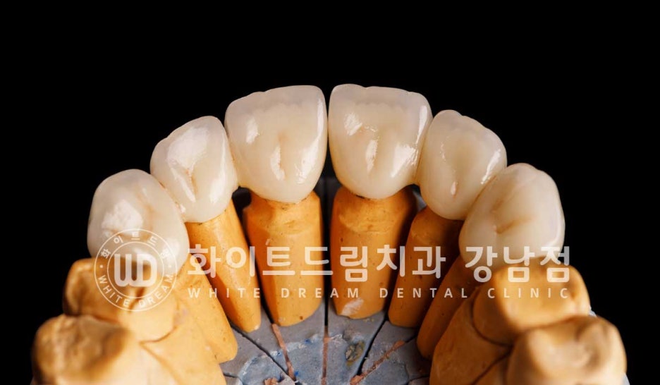 벌어지고 깨진 앞니, 웨딩 앞니 라미네이트 치료 사례 "남자도 자연스럽게 라미네이트 가능한가요?" 관련 이미지 11